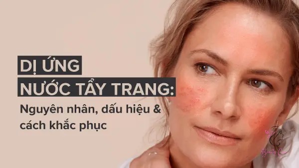 Da bỗng dưng nổi nhiều mụn hơn, đặc biệt là sau khi sử dụng một loại nước tẩy trang mới.